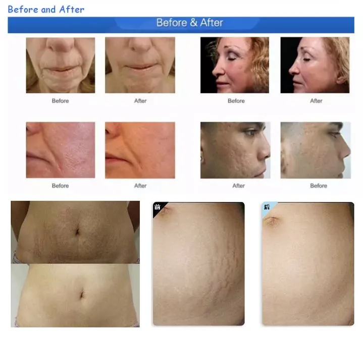 Fractional RF Mirconeedling Machine